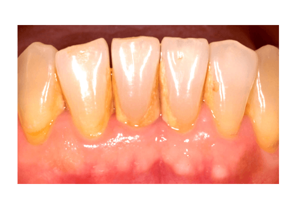 estetica dental, clinica dental point aviles, asturias, endodoncia, ortodoncia