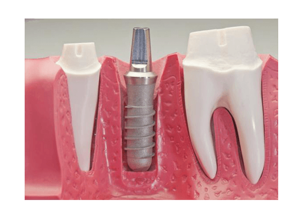 clinica dental point aviles, dentista asturies, ortodoncia, endodoncia
