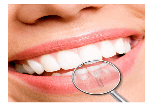 estetica dental, clinica dental point aviles, dentista asturias